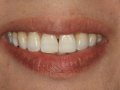 pre tx veneers  1600x1200  opt