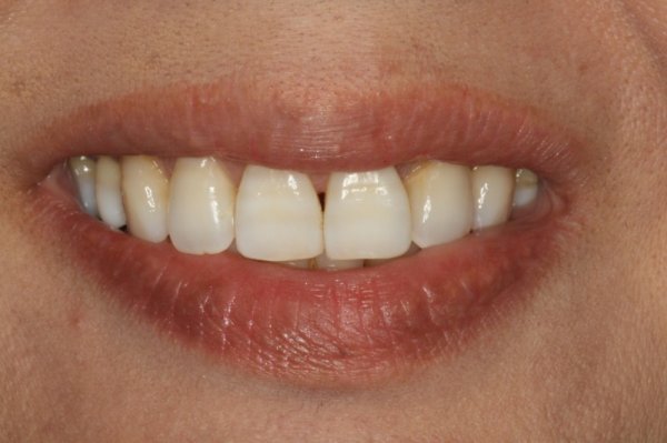 pre tx veneers  1600x1200  opt
